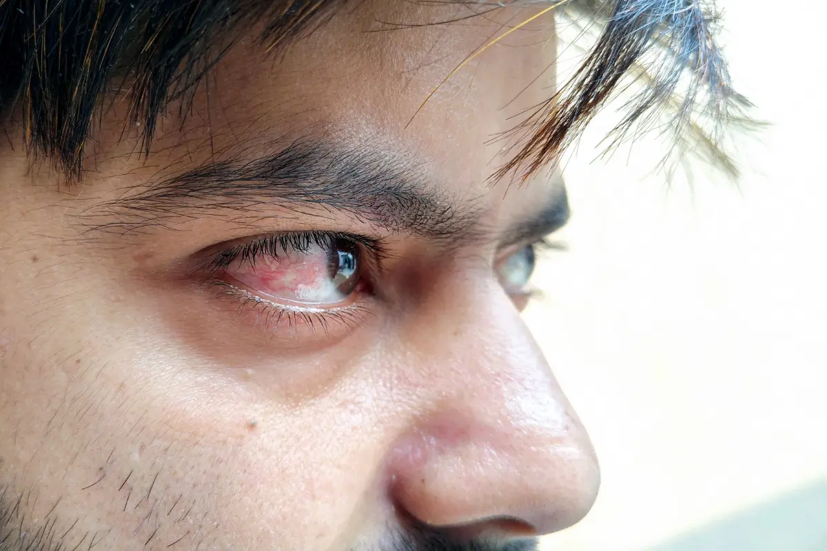 Close-up of bloodshot eyes, a physical sign used in reasonable suspicion drug testing